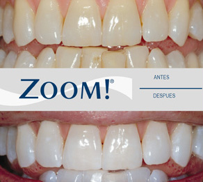 blanqueamiento dntal eixample